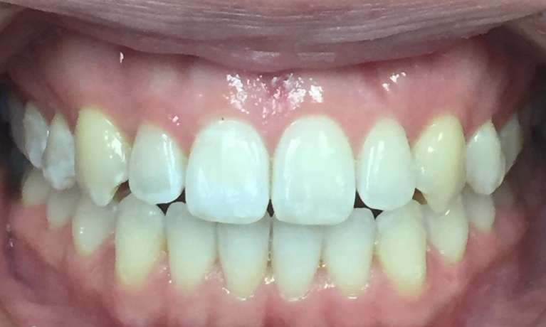 Invisalign-After-Image